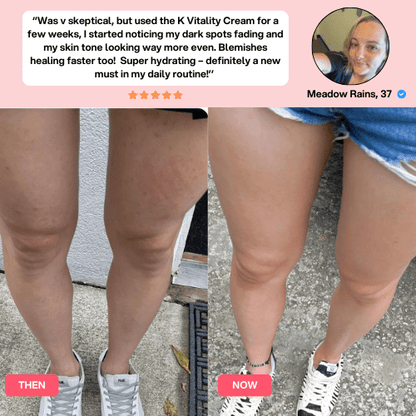SheVitality™ Anti Cellulite Sculpting Kit