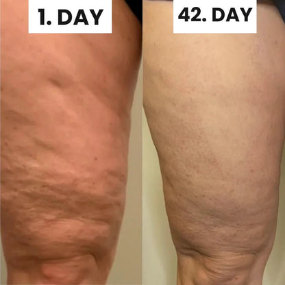 SheVitality™  Cellulite Relief Ultimate Kit