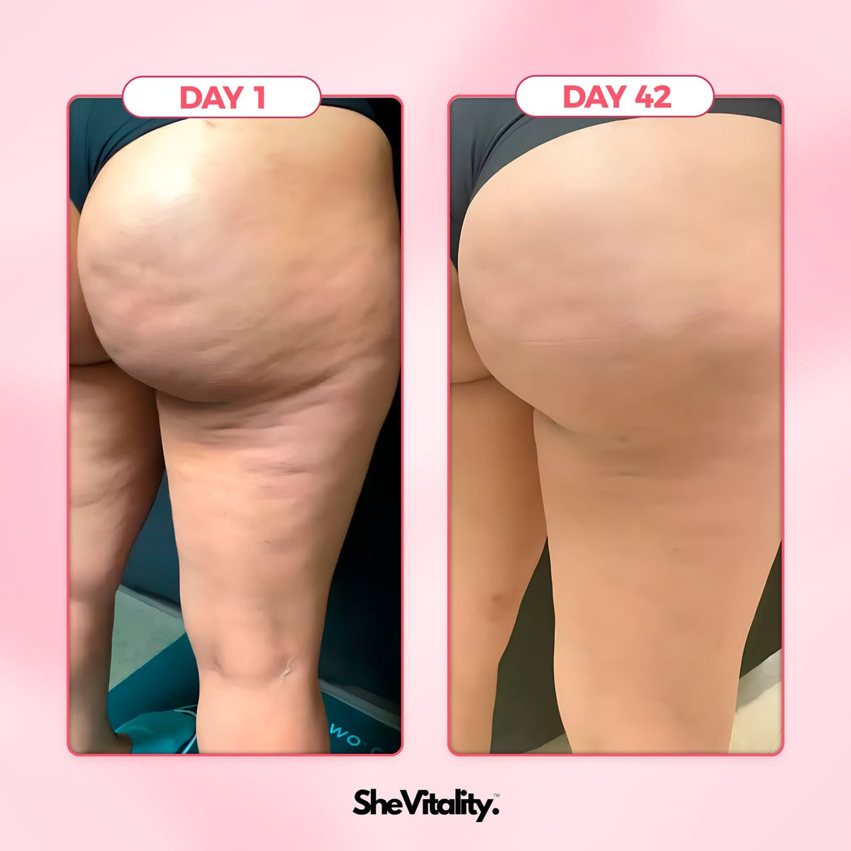SheVitality™  Cellulite Relief Kit